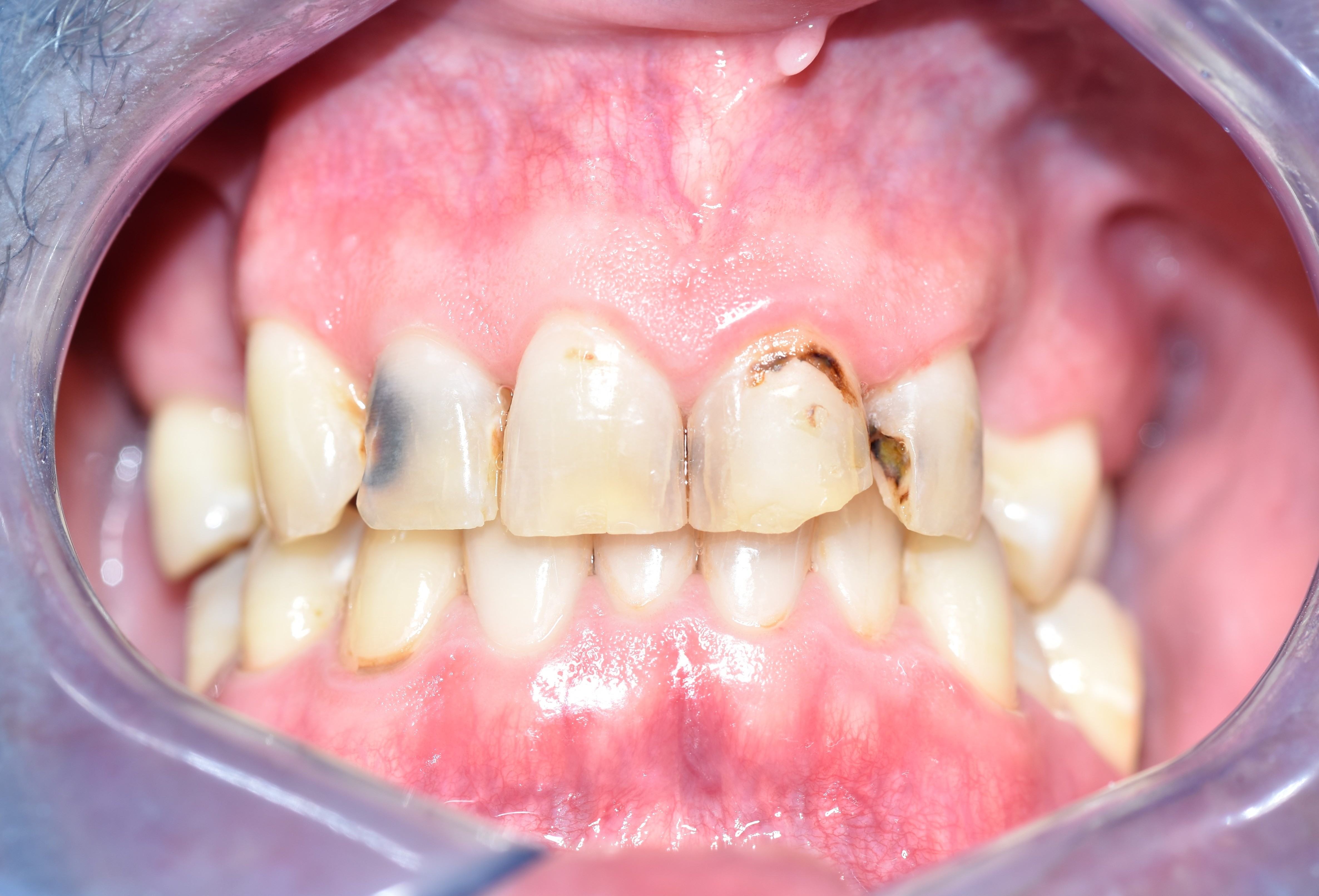 Before treatment